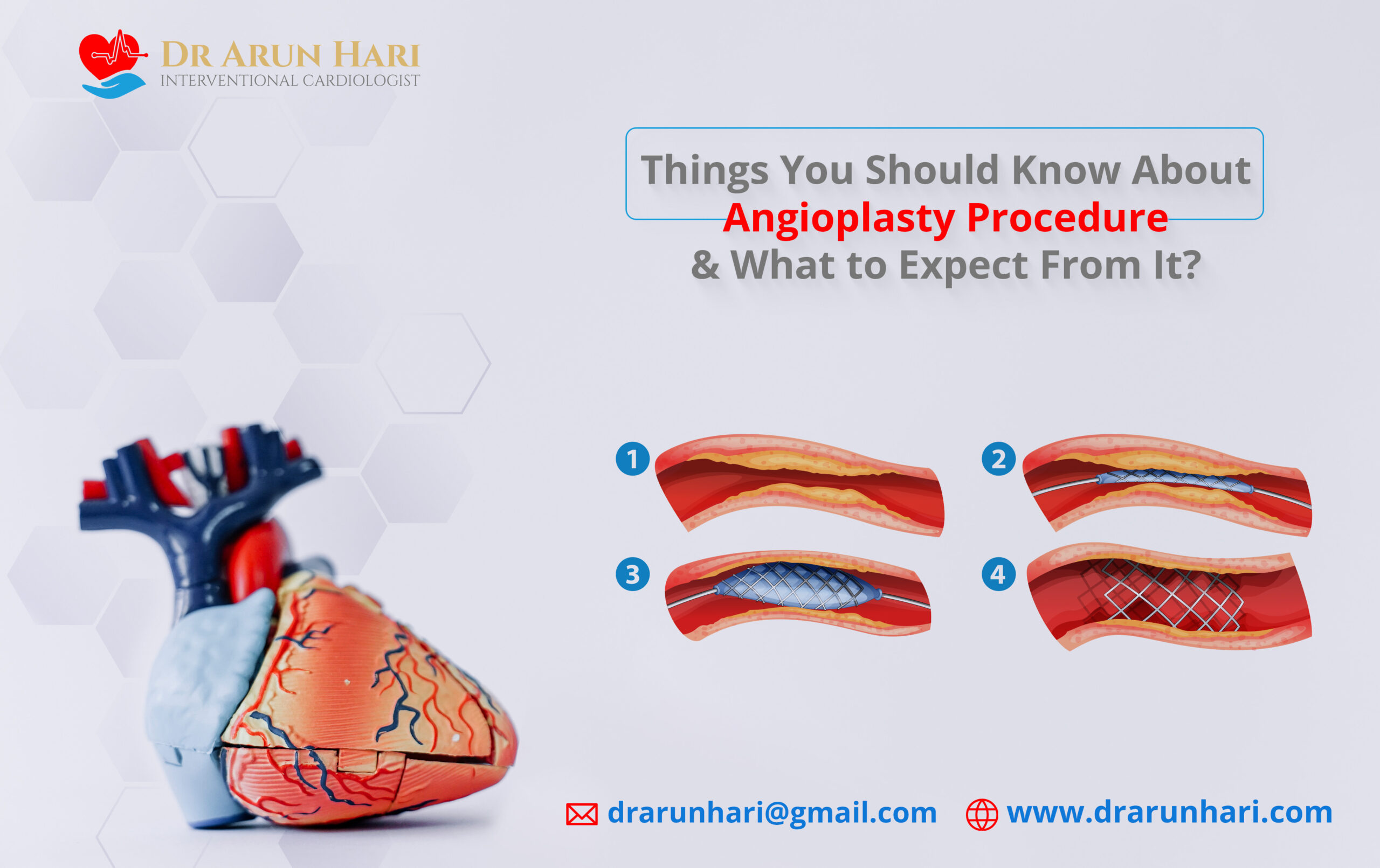 Read more about the article Angioplasty Procedure & What to Expect From It?