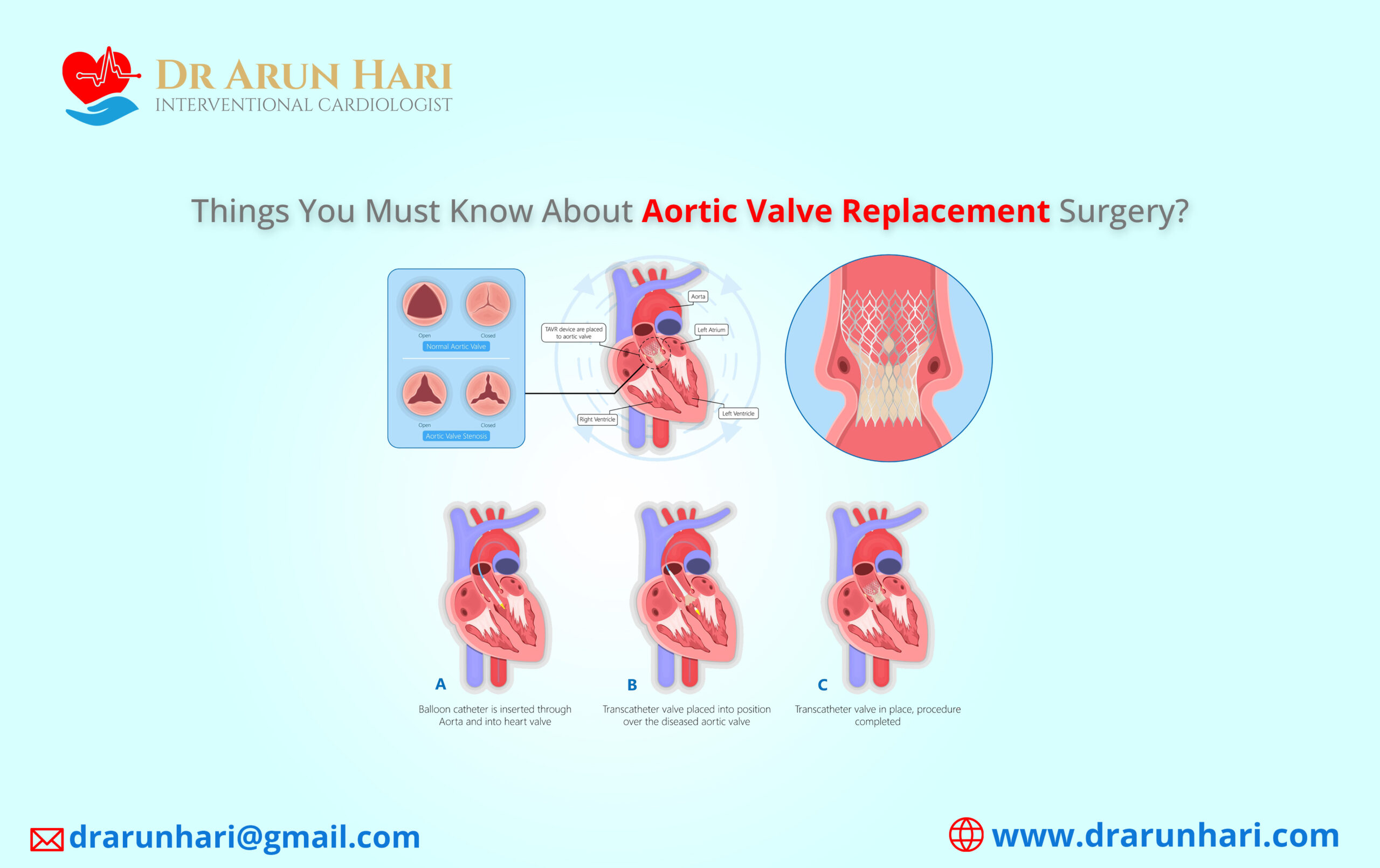 You are currently viewing Things to Know About Aortic Valve Replacement Surgery