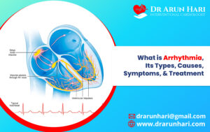 Read more about the article Arrhythmia, Its Types, Causes, Symptoms, & Treatment
