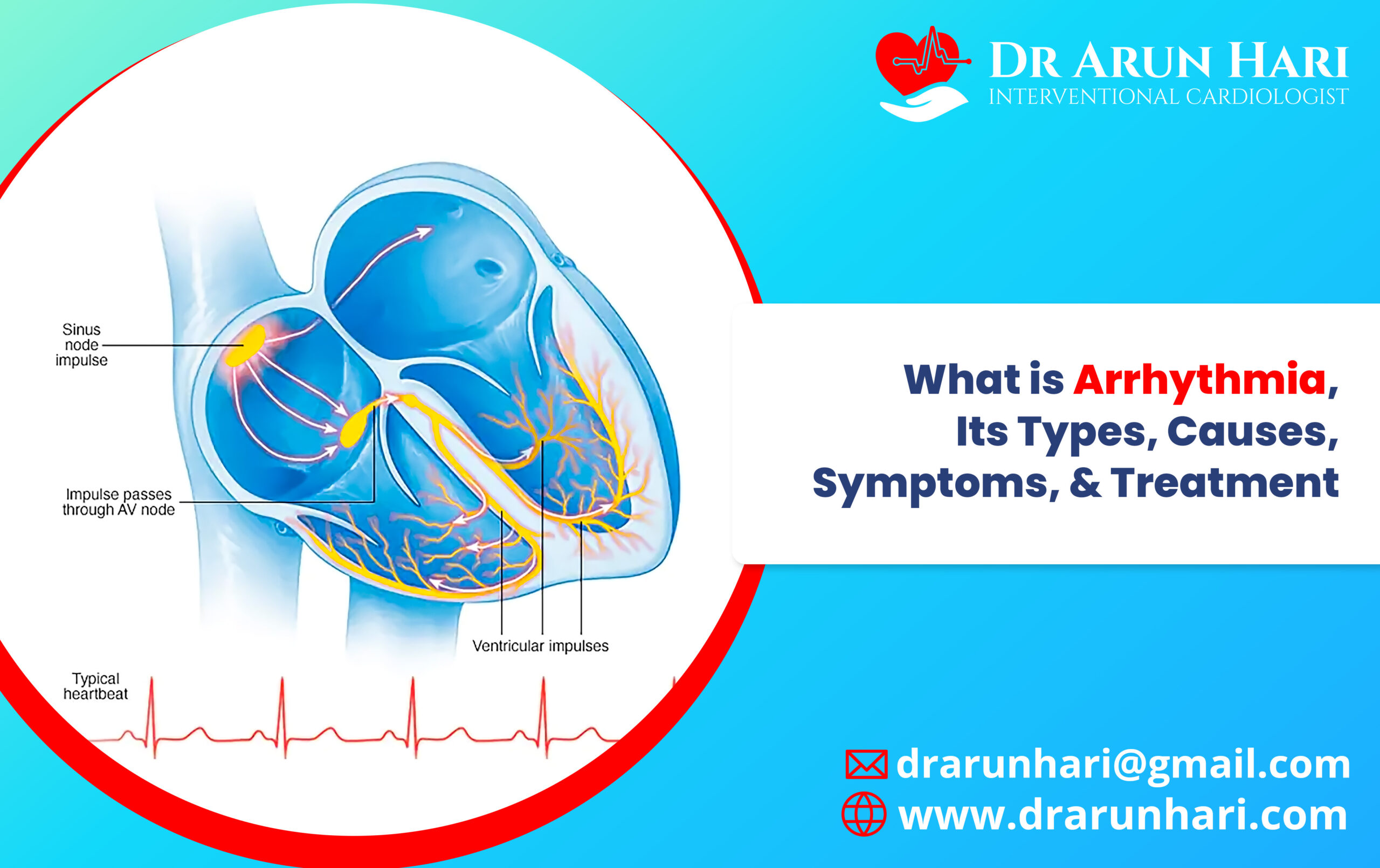 You are currently viewing Arrhythmia, Its Types, Causes, Symptoms, & Treatment
