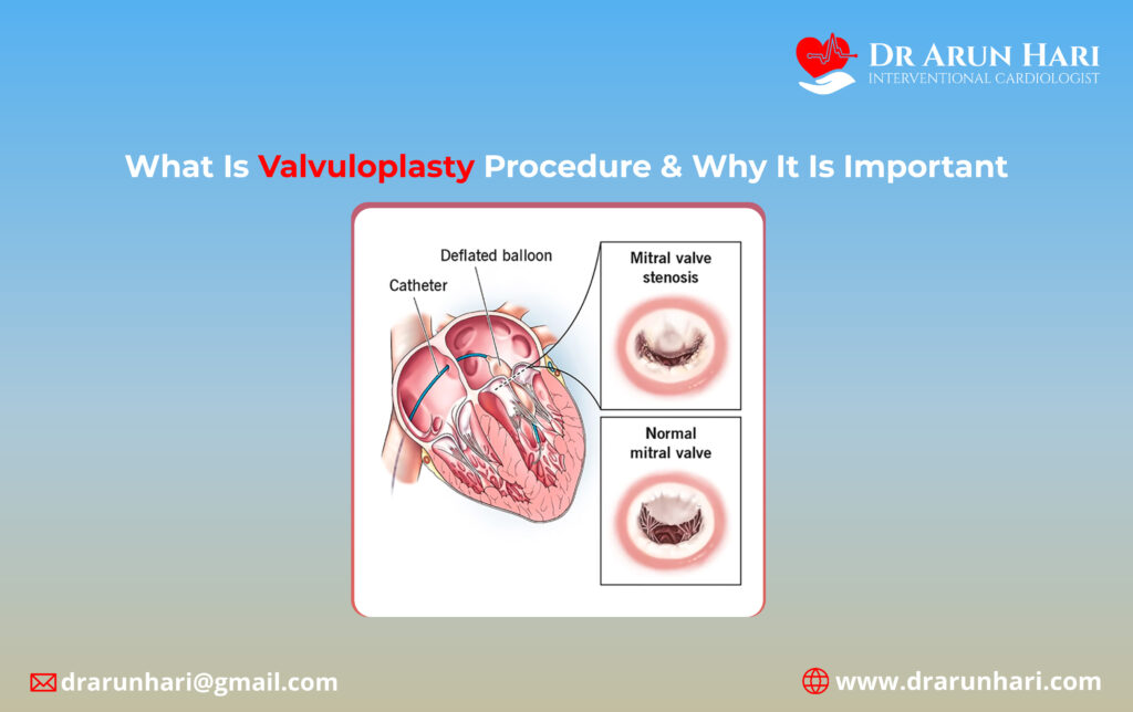 What Is Valvuloplasty Procedure & Why It Is Important?
