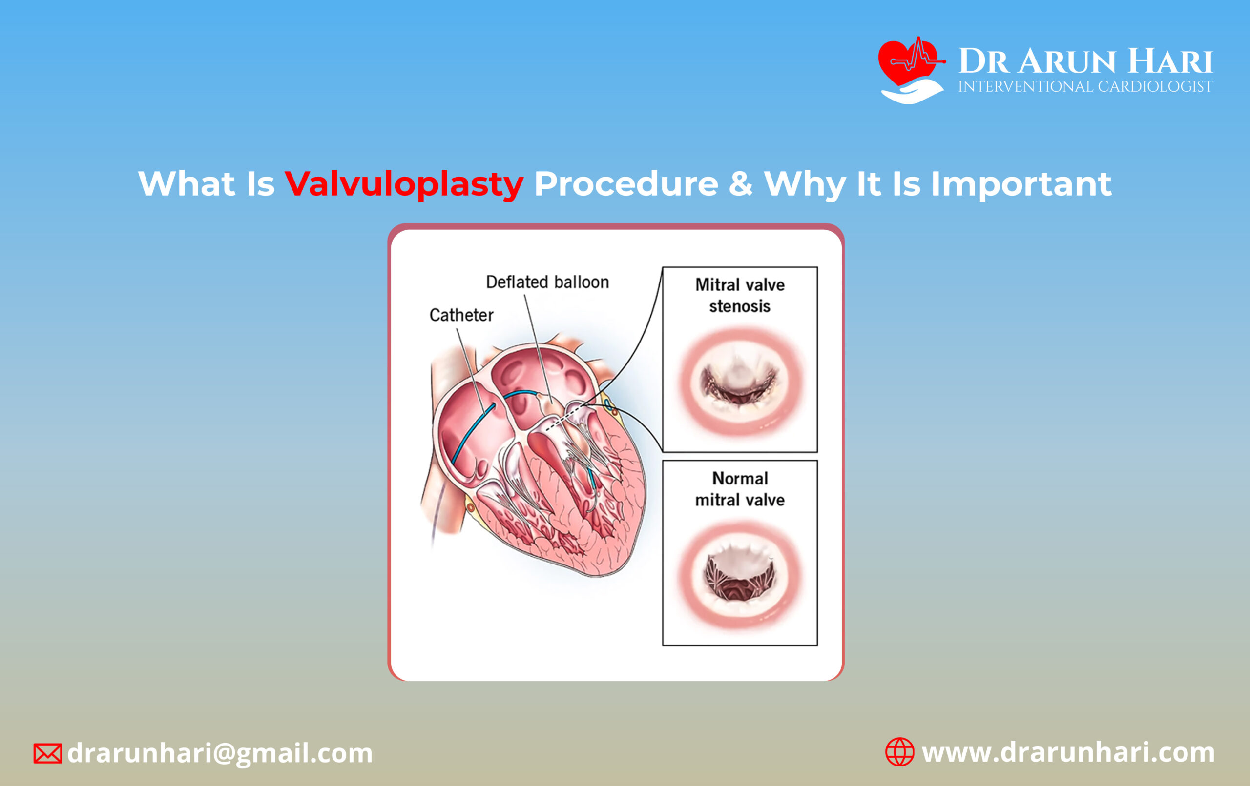 You are currently viewing What Is Valvuloplasty Procedure & Why It Is Important?