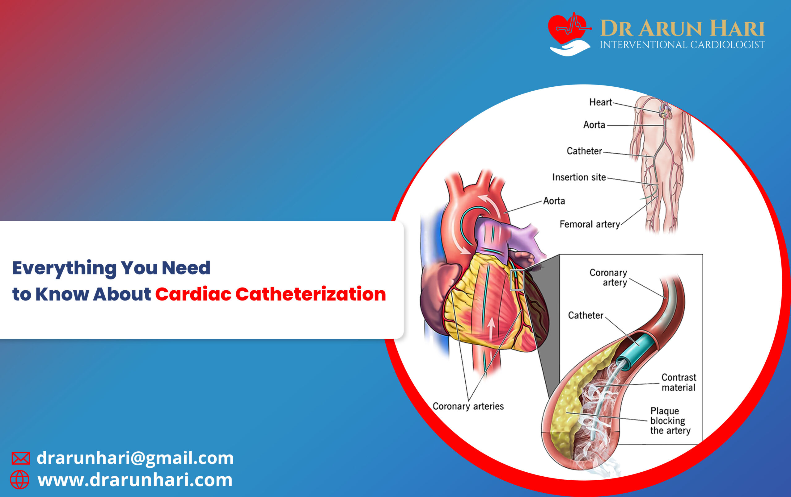 Read more about the article Everything You Need to Know About Cardiac Catheterization!