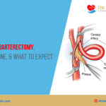 Carotid Endarterectomy – Why It’s Done & What to Expect?