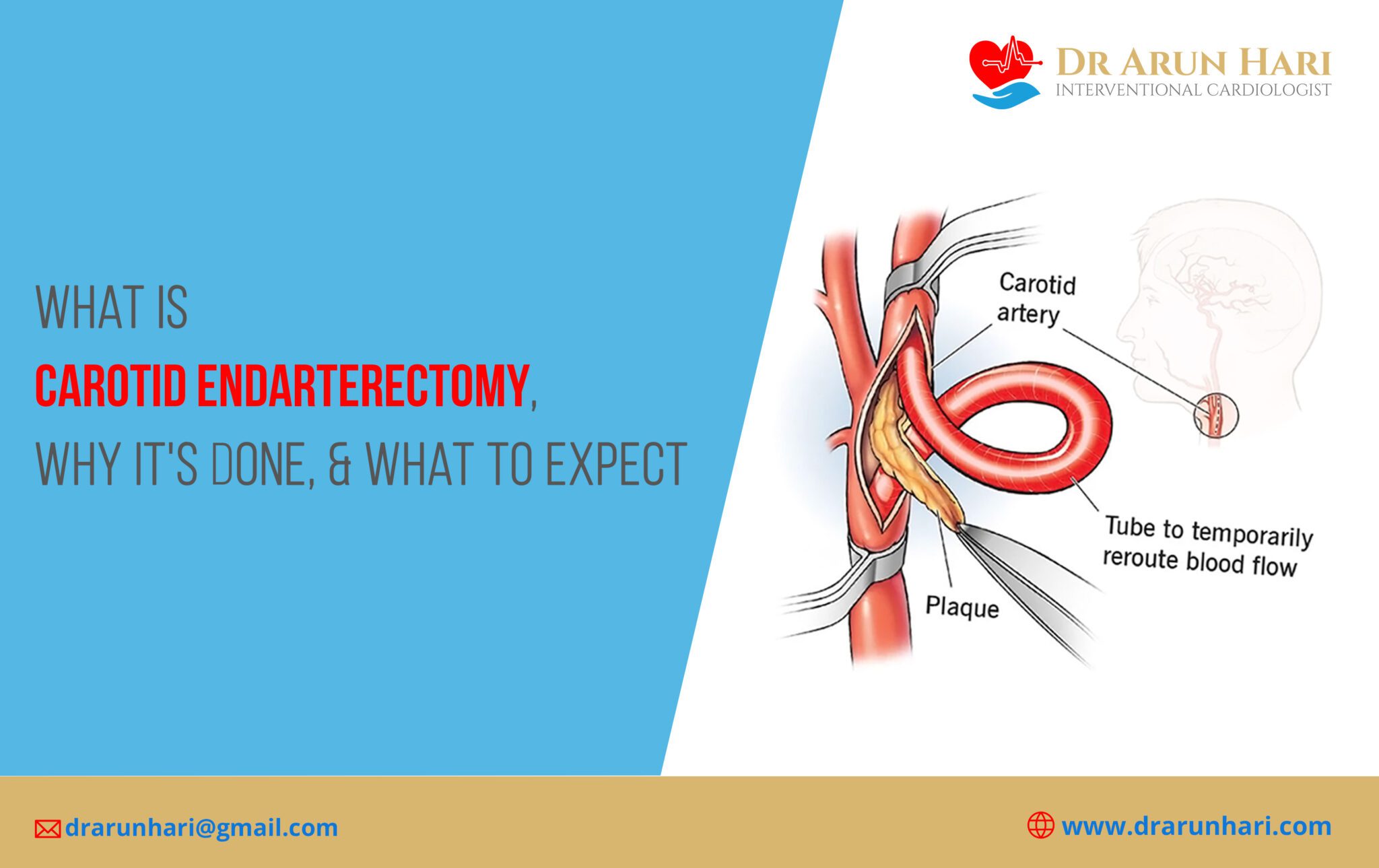 Carotid Endarterectomy - Why It's Done & What to Expect? - Dr Arun Hari