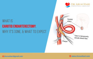 Read more about the article Carotid Endarterectomy – Why It’s Done & What to Expect?