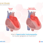 What Is Hypertrophic Cardiomyopathy, Its Causes, Symptoms, & Treatment?