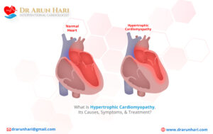 Read more about the article Hypertrophic Cardiomyopathy: Causes, Symptoms, & Treatment