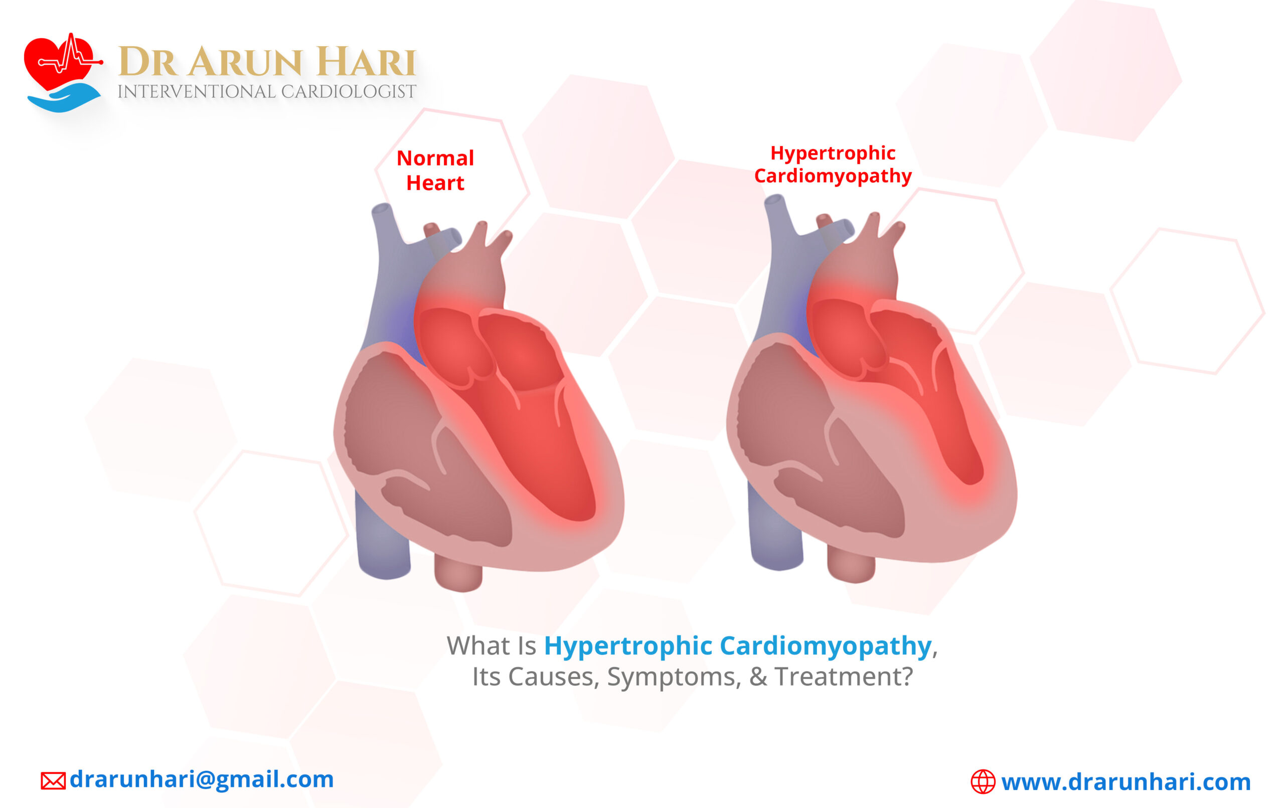Read more about the article What Is Hypertrophic Cardiomyopathy, Its Causes, Symptoms, & Treatment?
