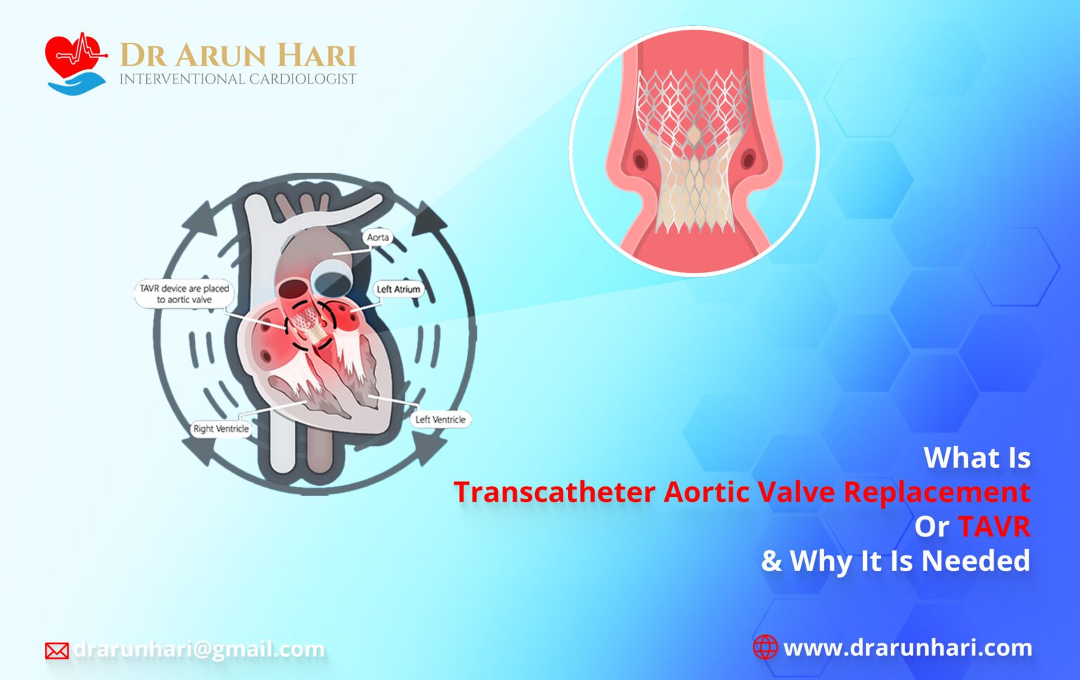 TAVR: Transcatheter Aortic Valve Replacement - Dr Arun Hari