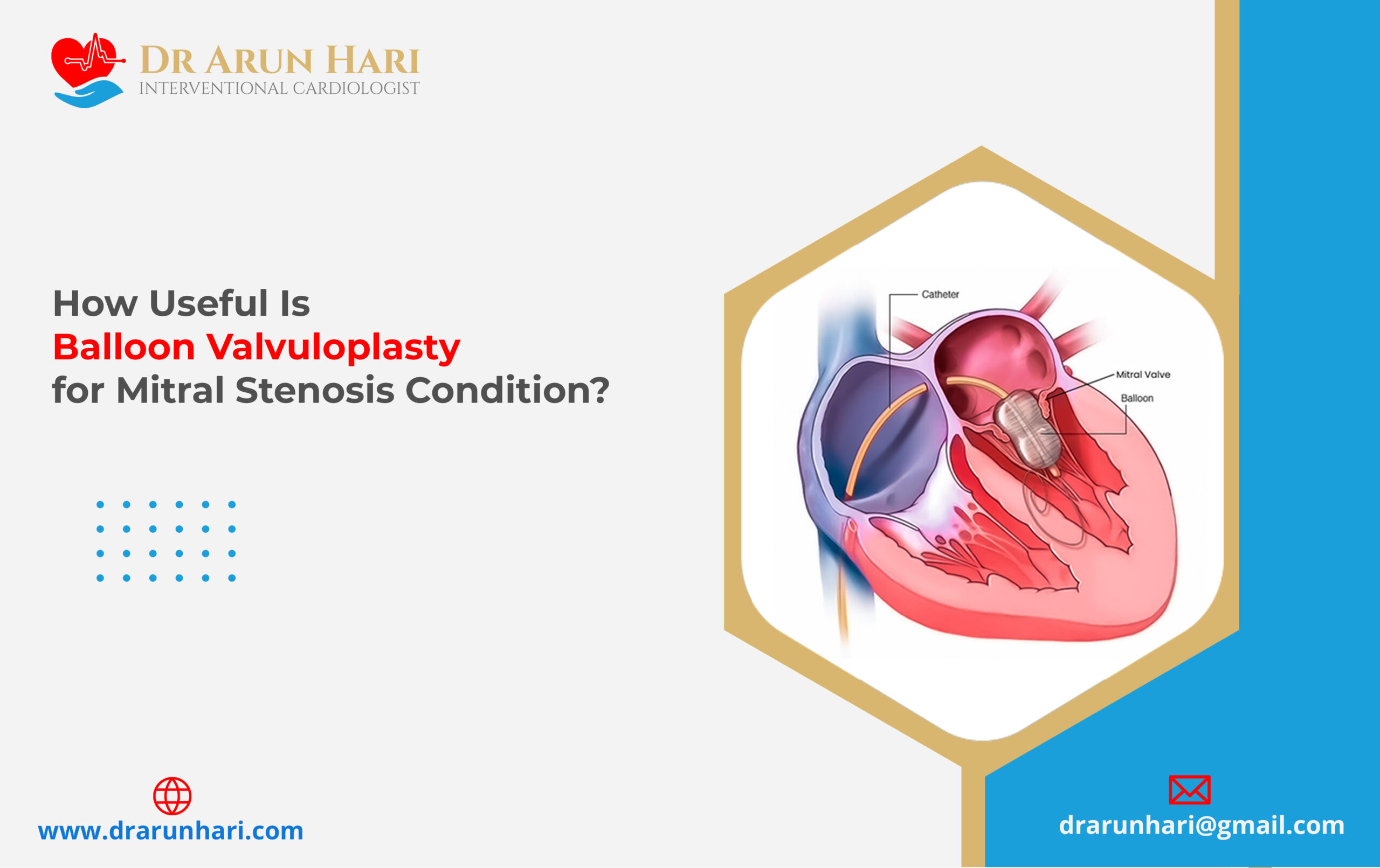 You are currently viewing Balloon Valvuloplasty for Mitral Stenosis – How Useful Is It?