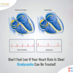 Don’t Feel Low If Your Heart Rate Is Slow! Bradycardia Can Be Treated!