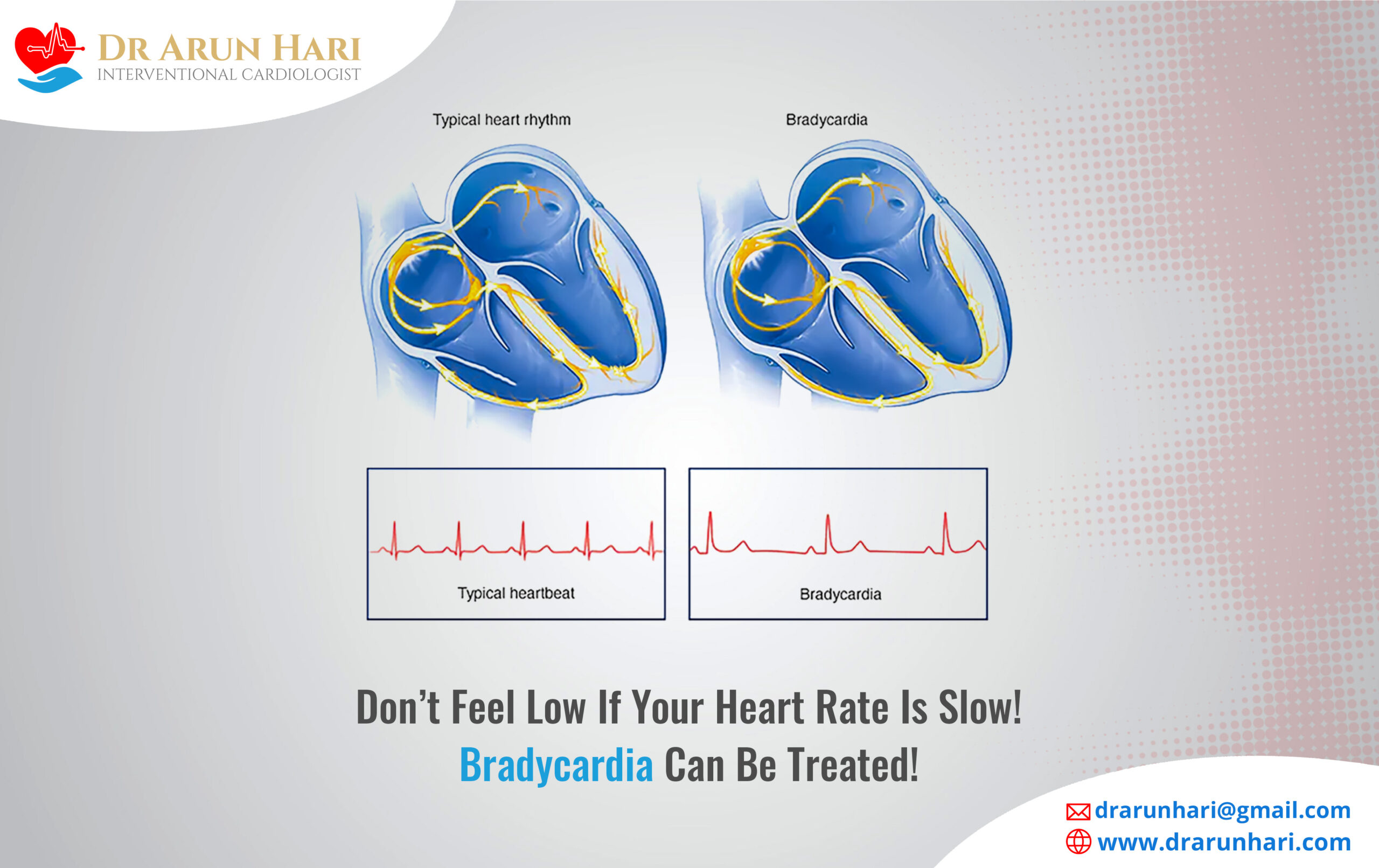 You are currently viewing Don’t Feel Low If Your Heart Rate Is Slow! Bradycardia Can Be Treated!