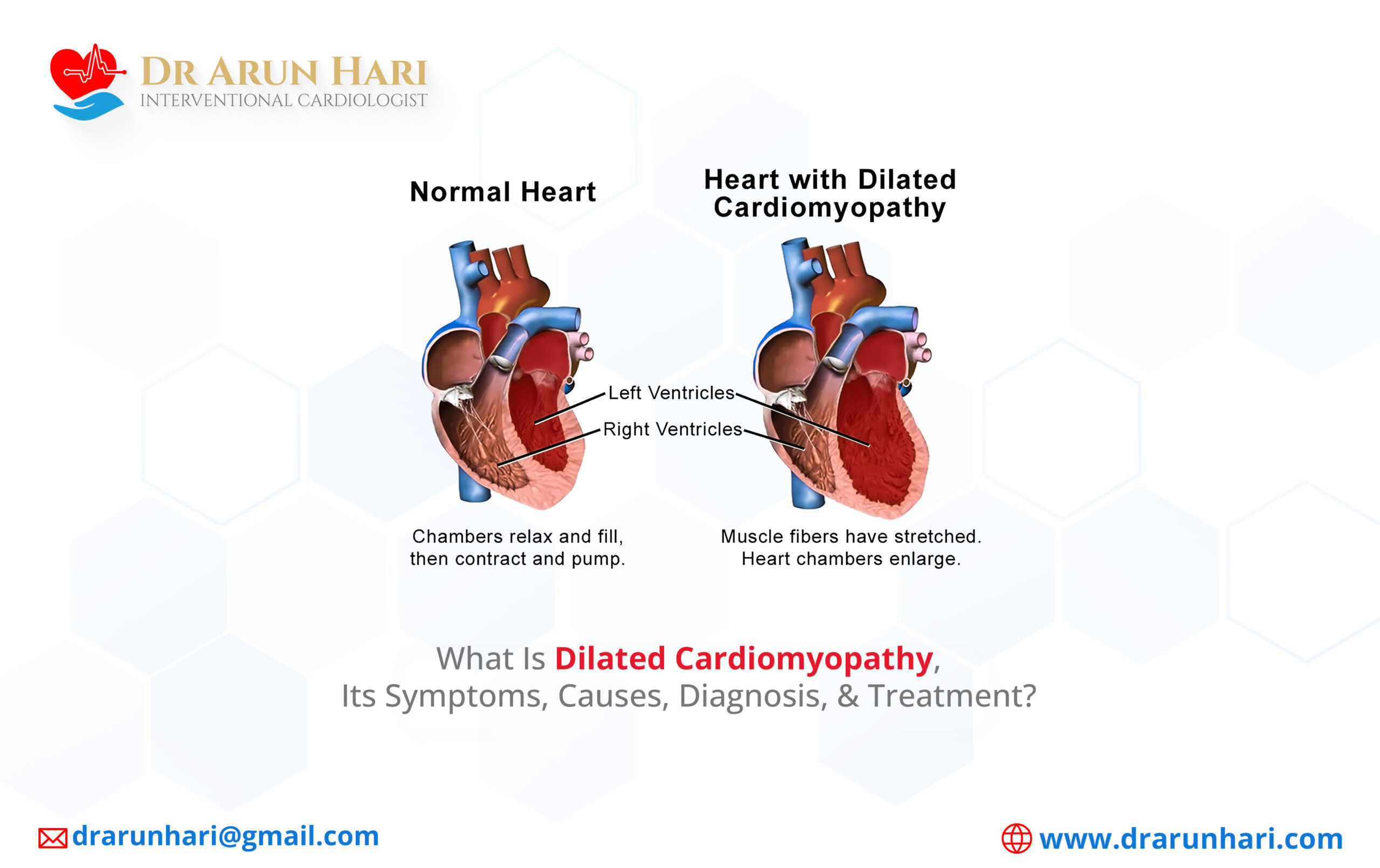 Read more about the article What Is Dilated Cardiomyopathy, Its Symptoms, Causes, Diagnosis, & Treatment?