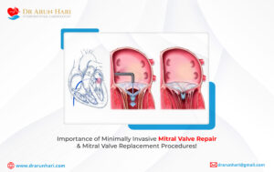 Read more about the article Minimally Invasive Mitral Valve Repair & Replacement: Importance