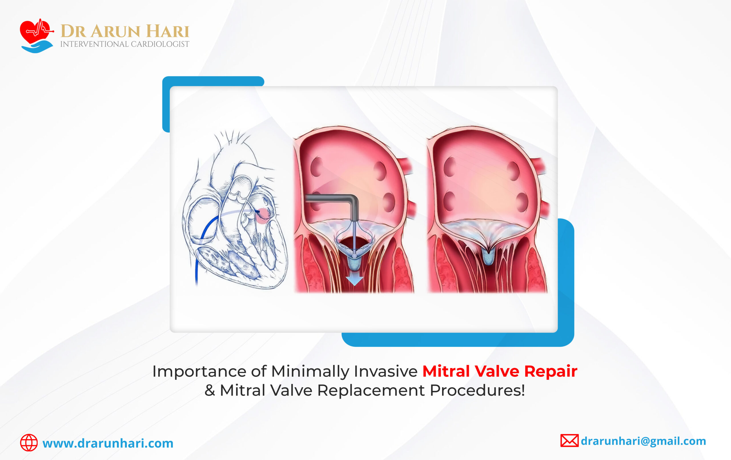 Read more about the article Importance of Minimally Invasive Mitral Valve Repair & Mitral Valve Replacement Procedures!