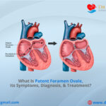Patent Foramen Ovale – Symptoms, Diagnosis, & Treatment
