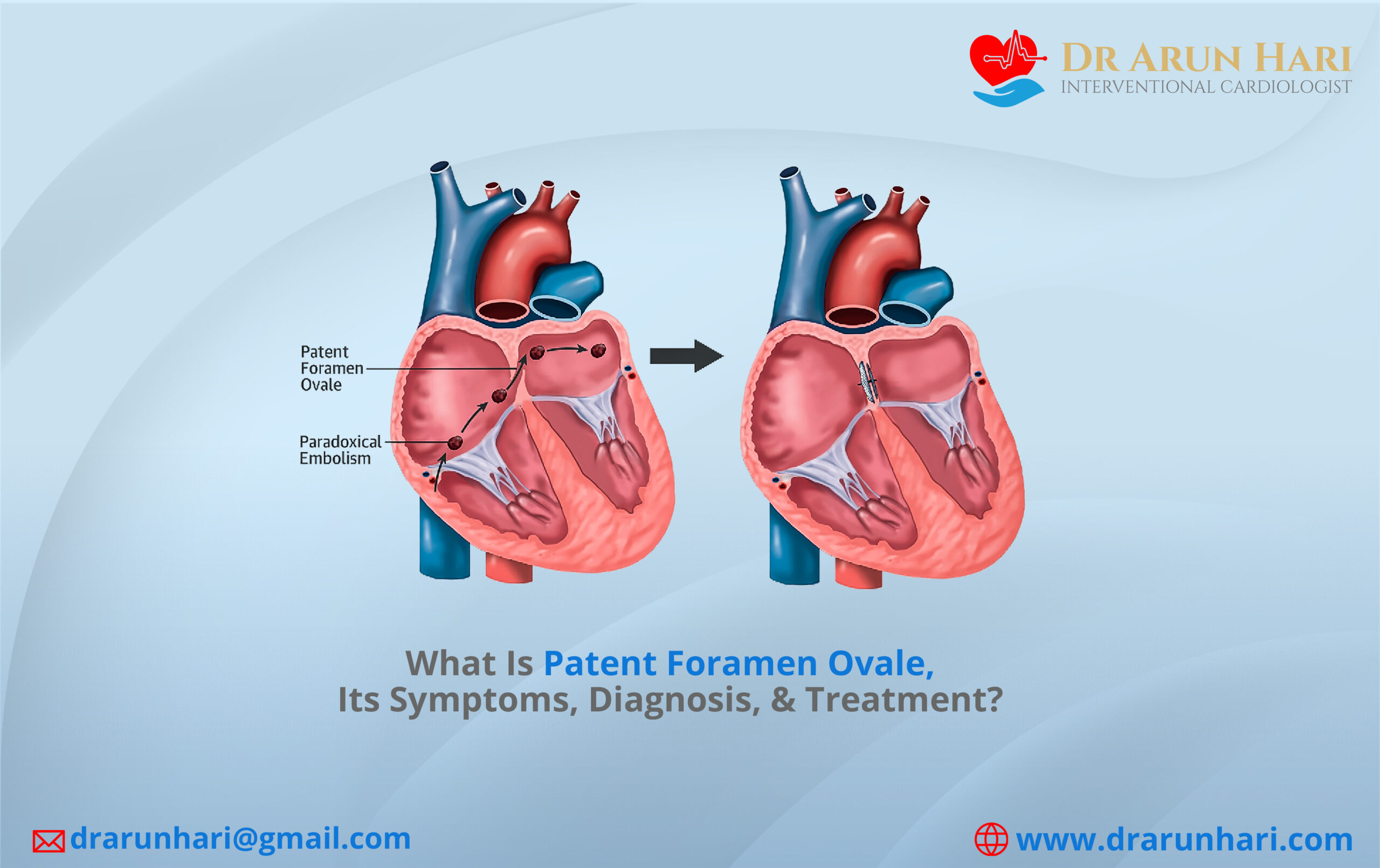Read more about the article Patent Foramen Ovale – Symptoms, Diagnosis, & Treatment