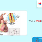 What Is A STEMI Heart Attack?