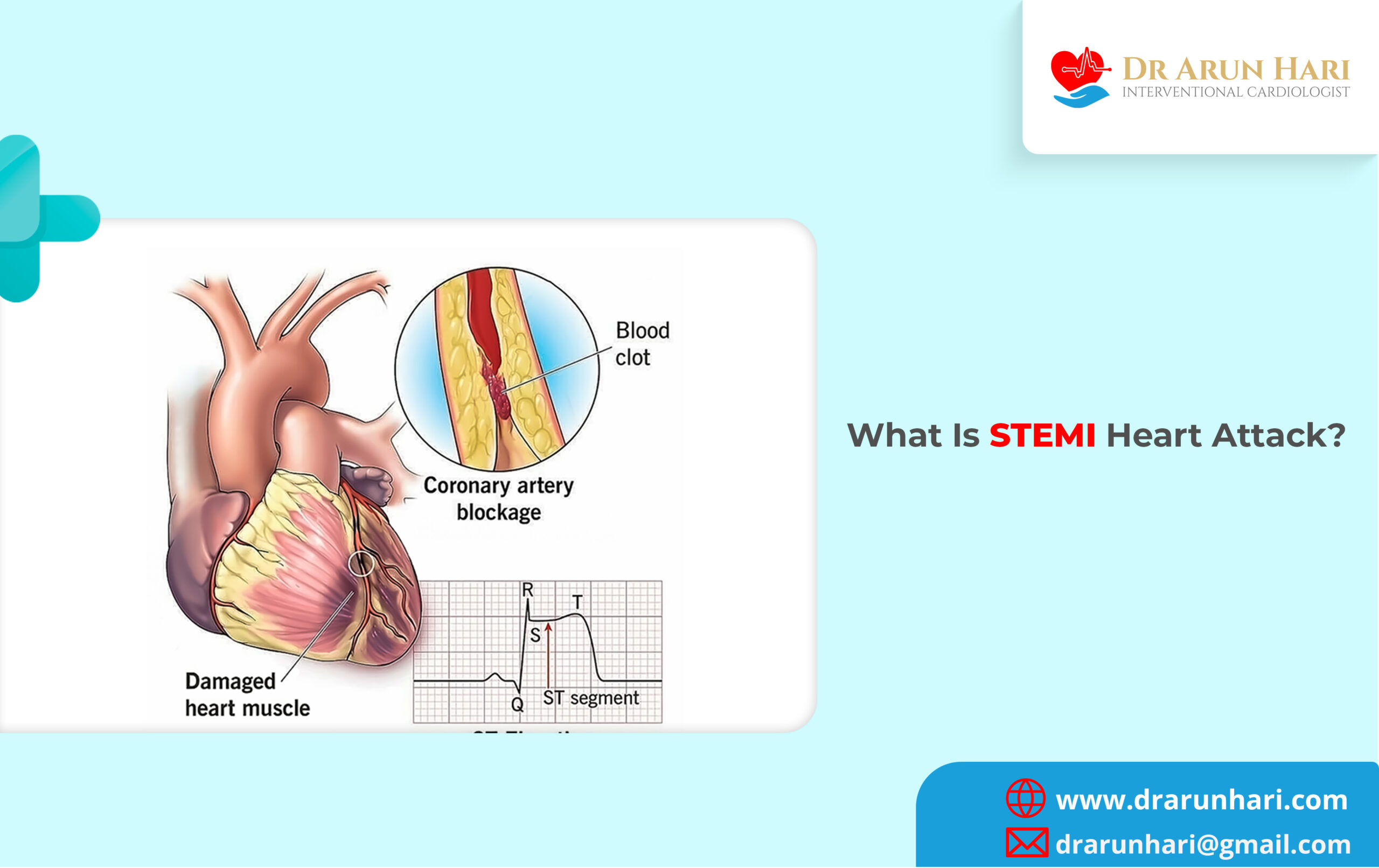 Read more about the article What Is A STEMI Heart Attack?