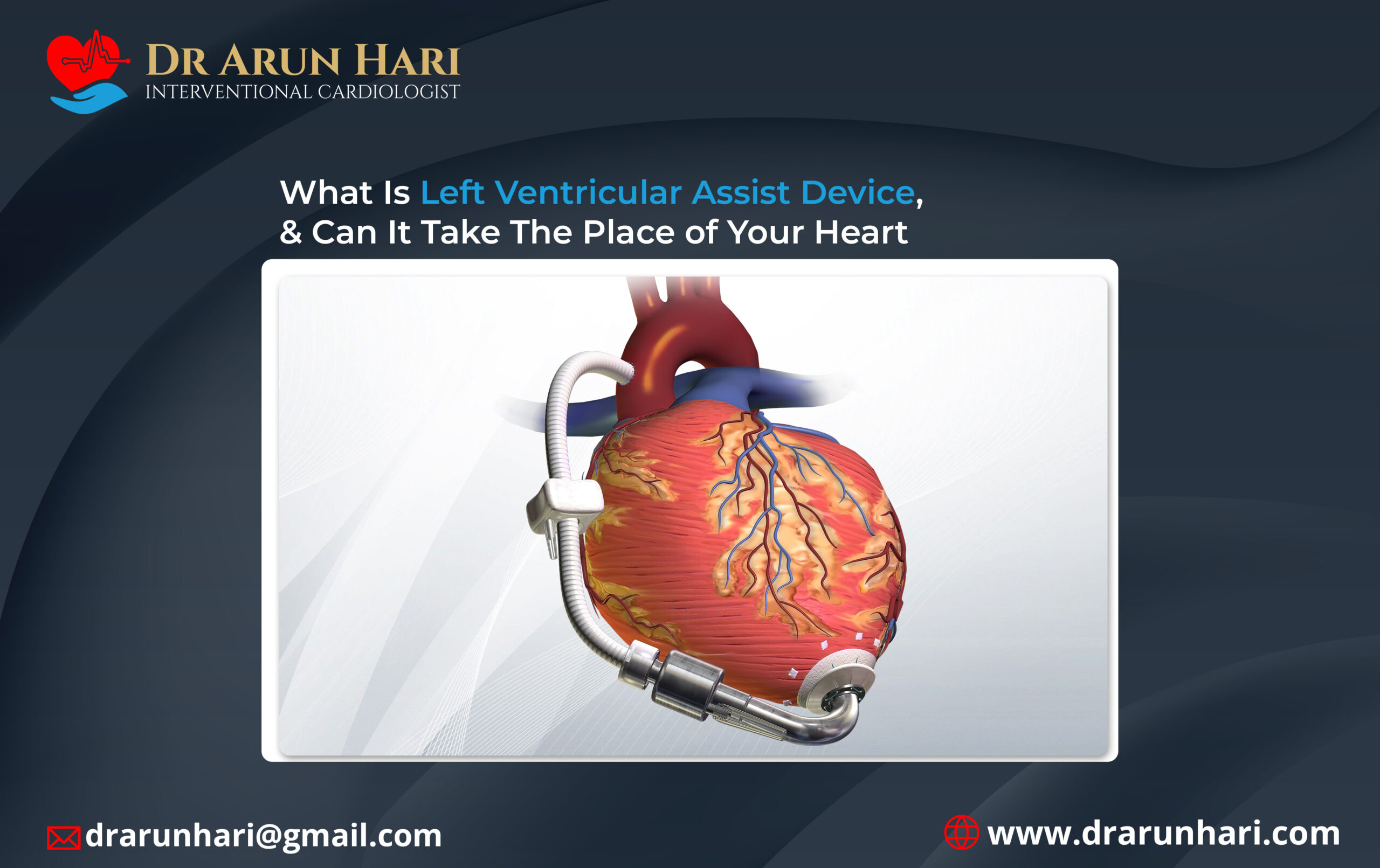 Read more about the article What Is LVAD?