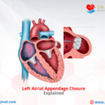 Left Atrial Appendage Closure Explained