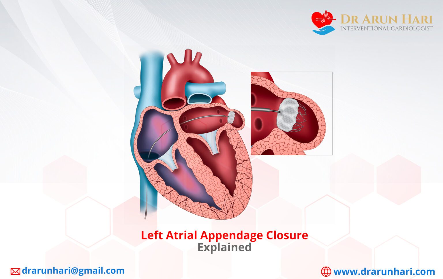 Left Atrial Appendage Closure Explained - Dr Arun Hari