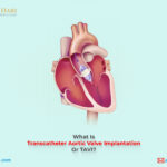 What Is Transcatheter Aortic Valve Implantation Or TAVI?