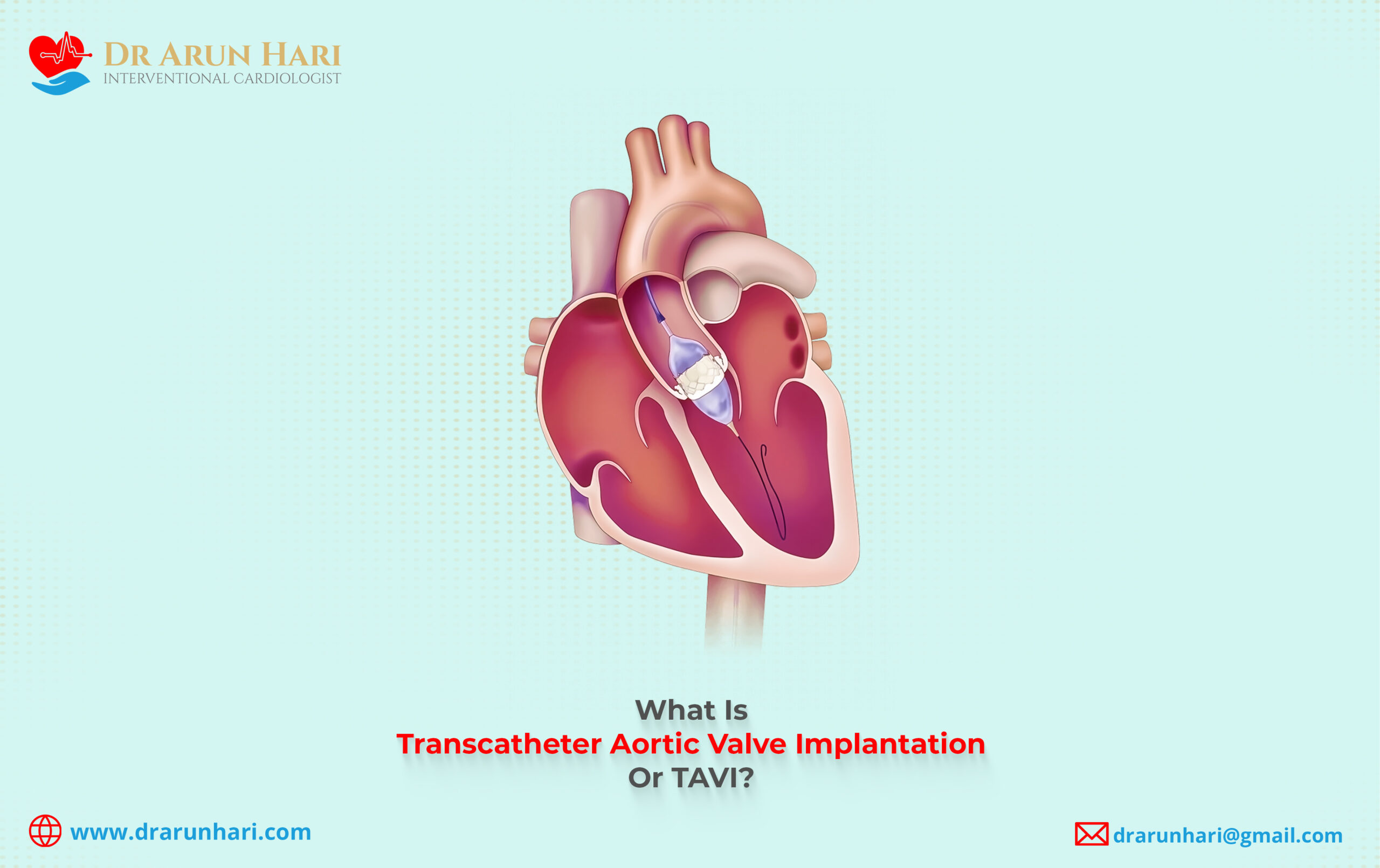 You are currently viewing What Is Transcatheter Aortic Valve Implantation Or TAVI?
