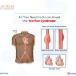 Marfan Syndrome – All You Need to Know!
