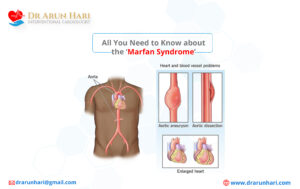 Read more about the article Marfan Syndrome – All You Need to Know!