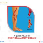 A Quick Read on Peripheral Artery Disease