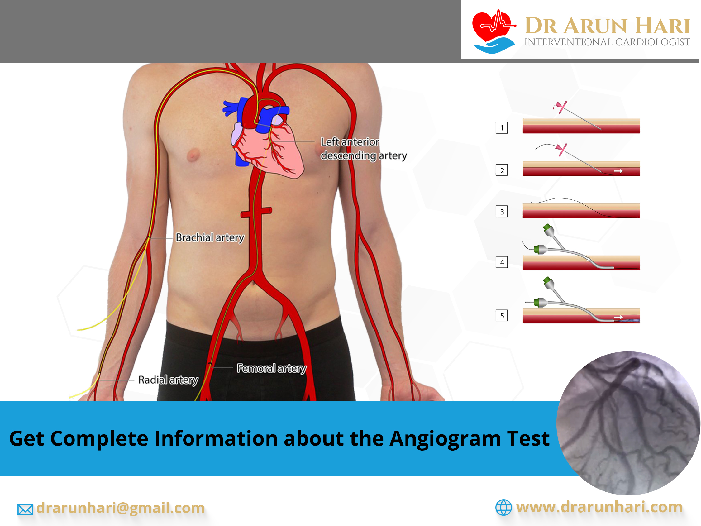 Read more about the article Get Complete Information about the Angiogram Test
