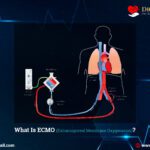 What Is ECMO (Extracorporeal Membrane Oxygenation)?