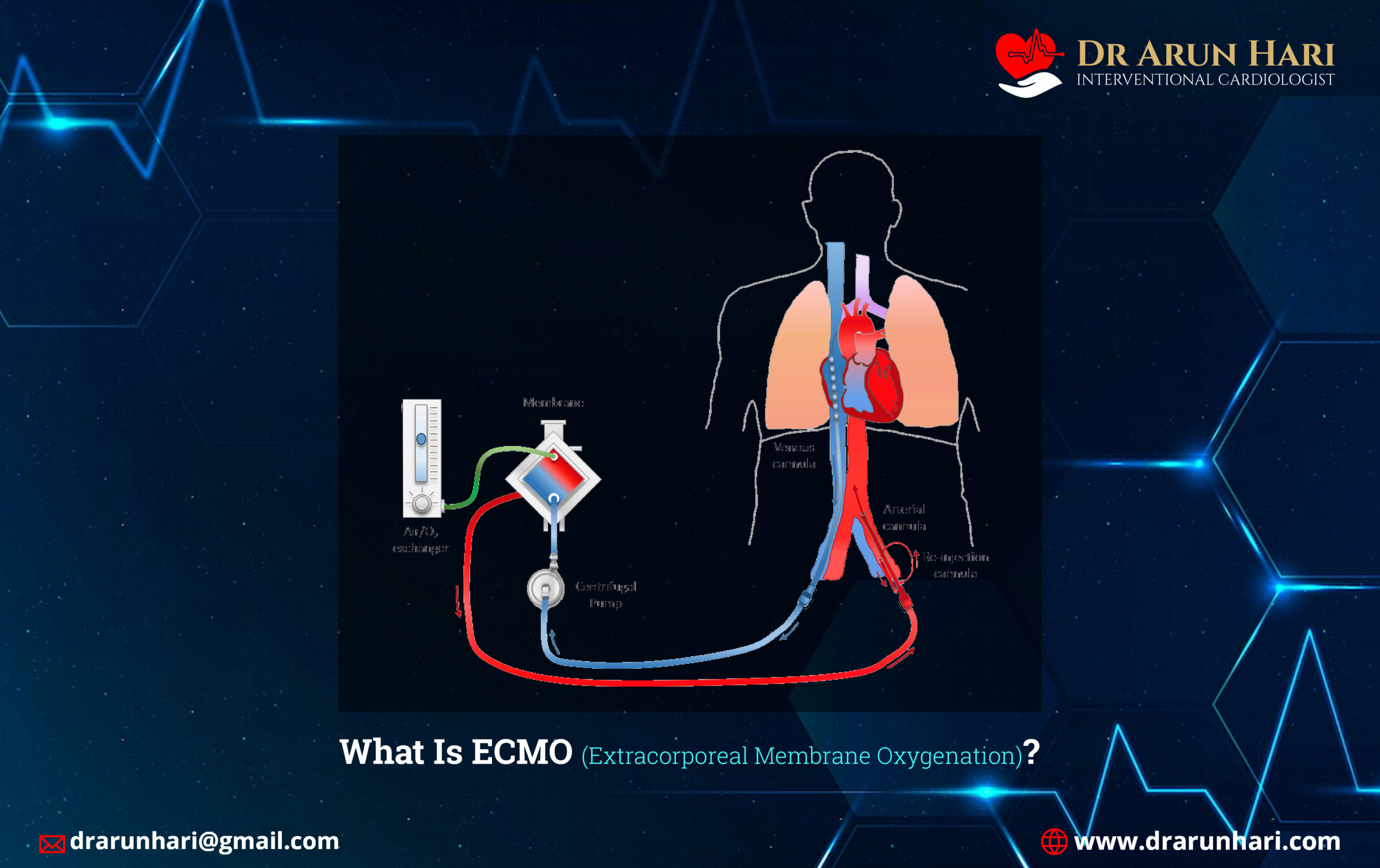 You are currently viewing What Is ECMO (Extracorporeal Membrane Oxygenation)?