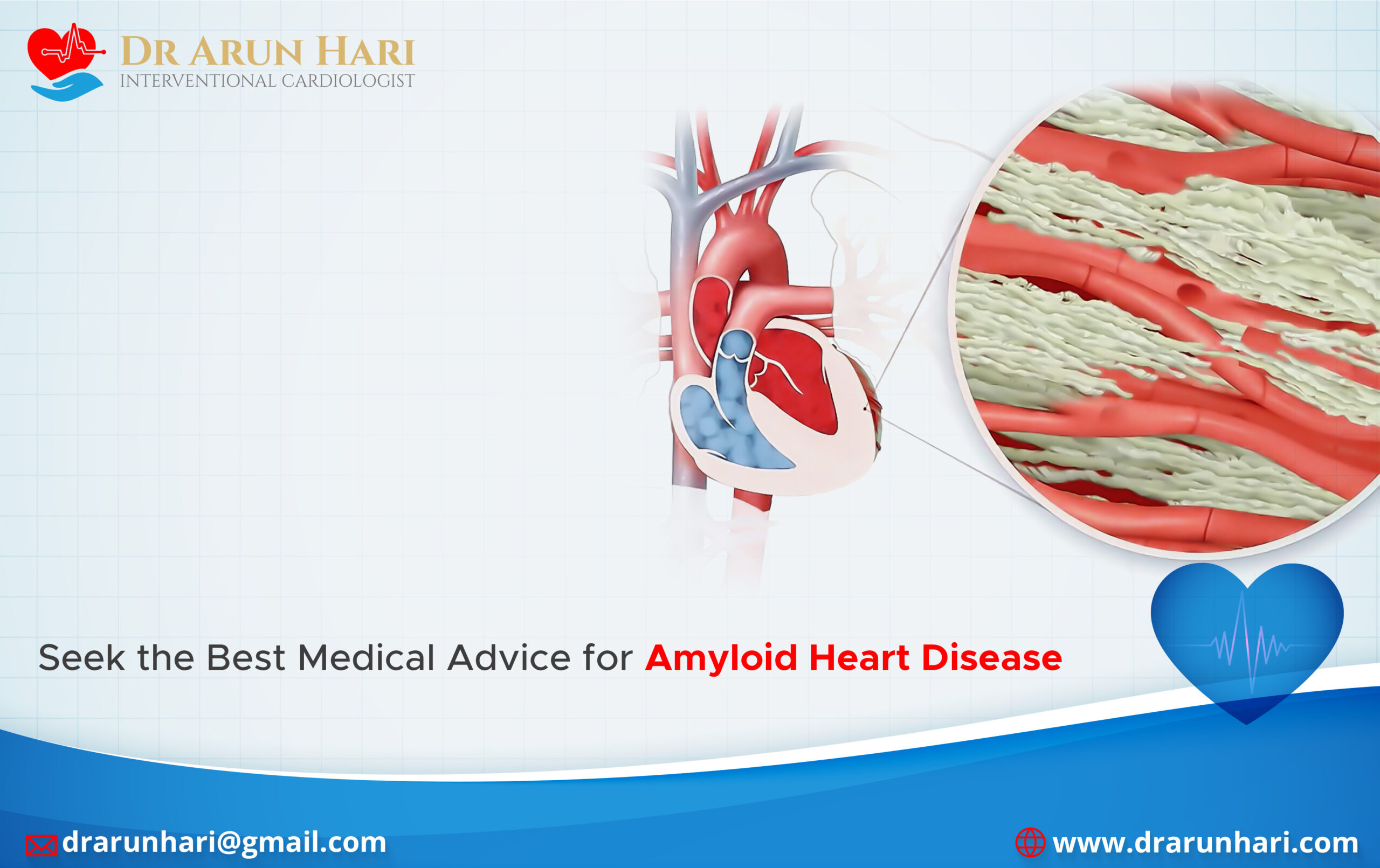 Read more about the article Seek the Best Medical Advice for Amyloid Heart Disease