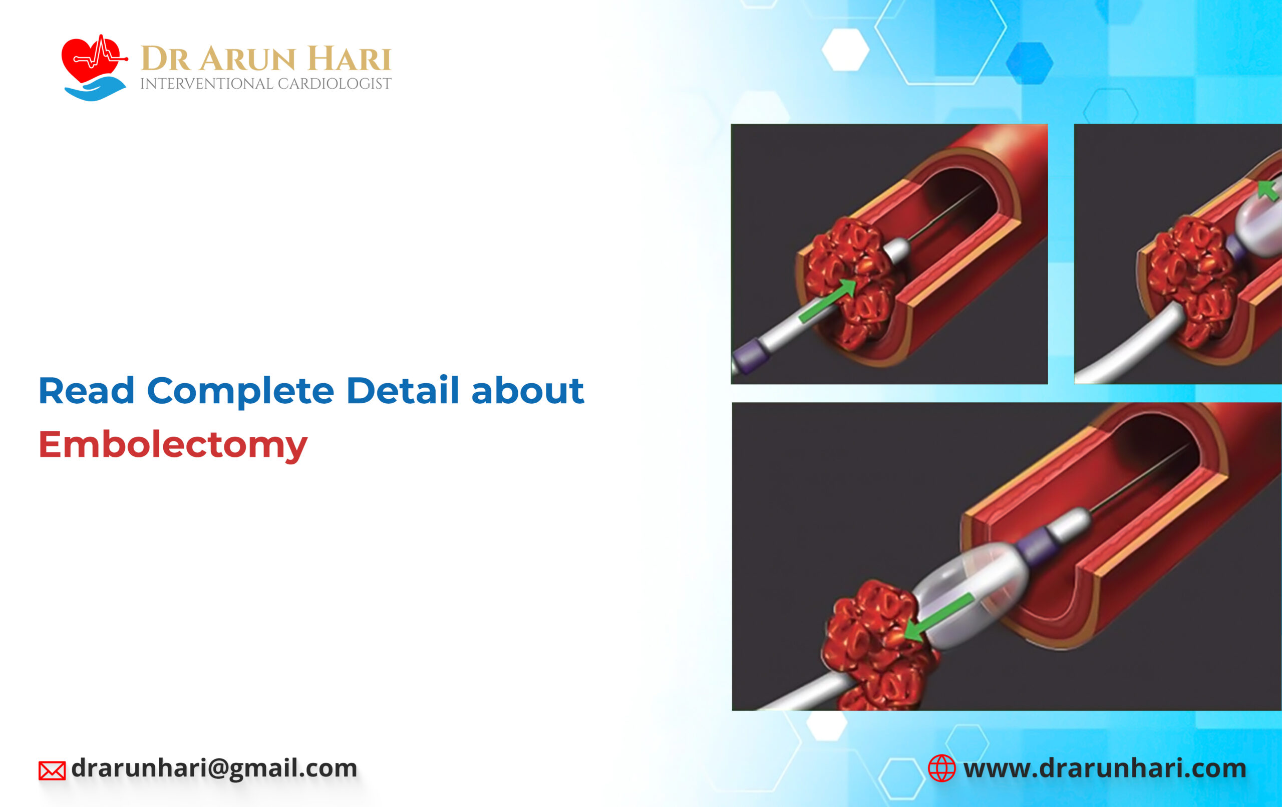 Read more about the article Read Complete Detail about Embolectomy