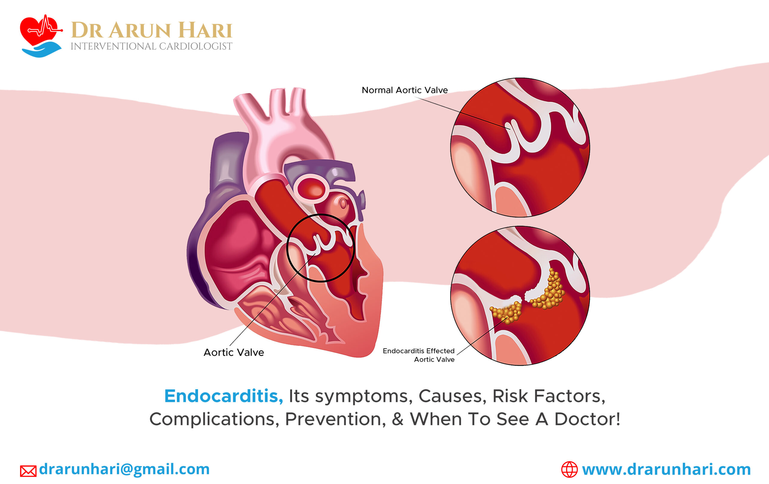 Read more about the article Endocarditis, Its symptoms, Causes, Risk Factors, Complications, Prevention, & When To See A Doctor!