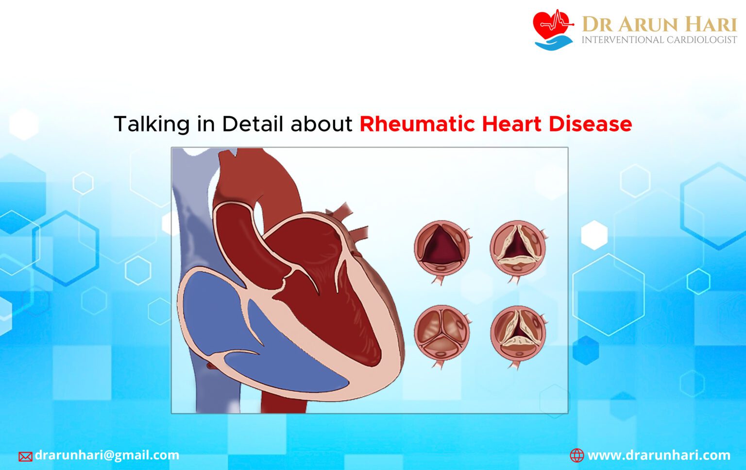 Talking In Detail About Rheumatic Heart Disease Dr Arun Hari