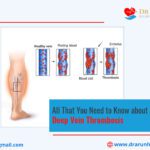 All That You Need to Know about Deep Vein Thrombosis