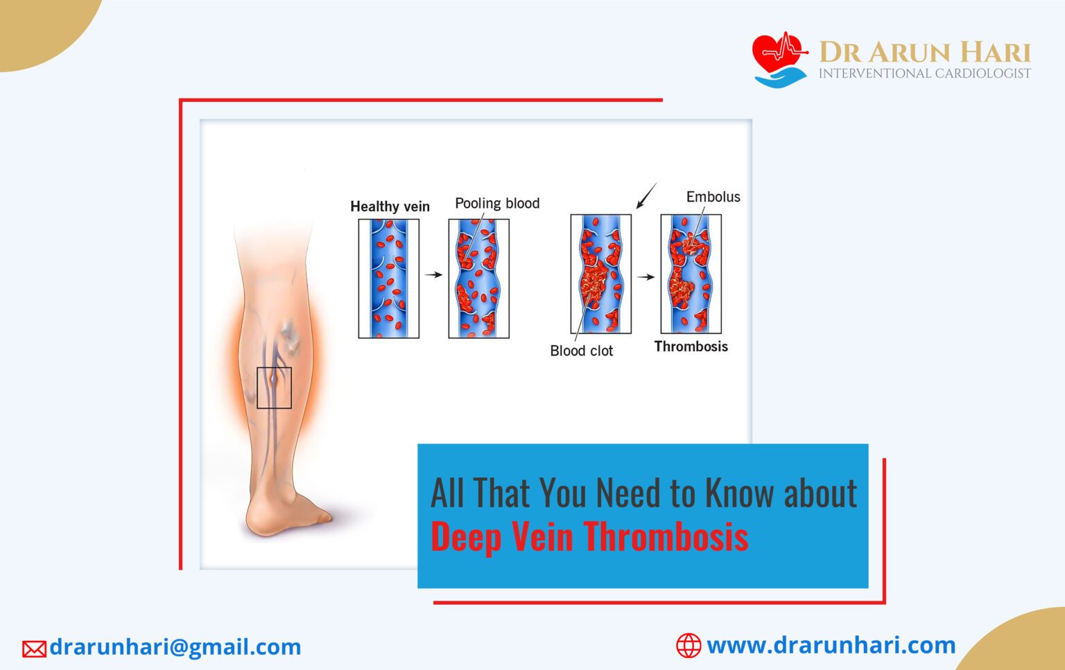 Deep Vein Thrombosis: What to Know - Dr Arun Hari