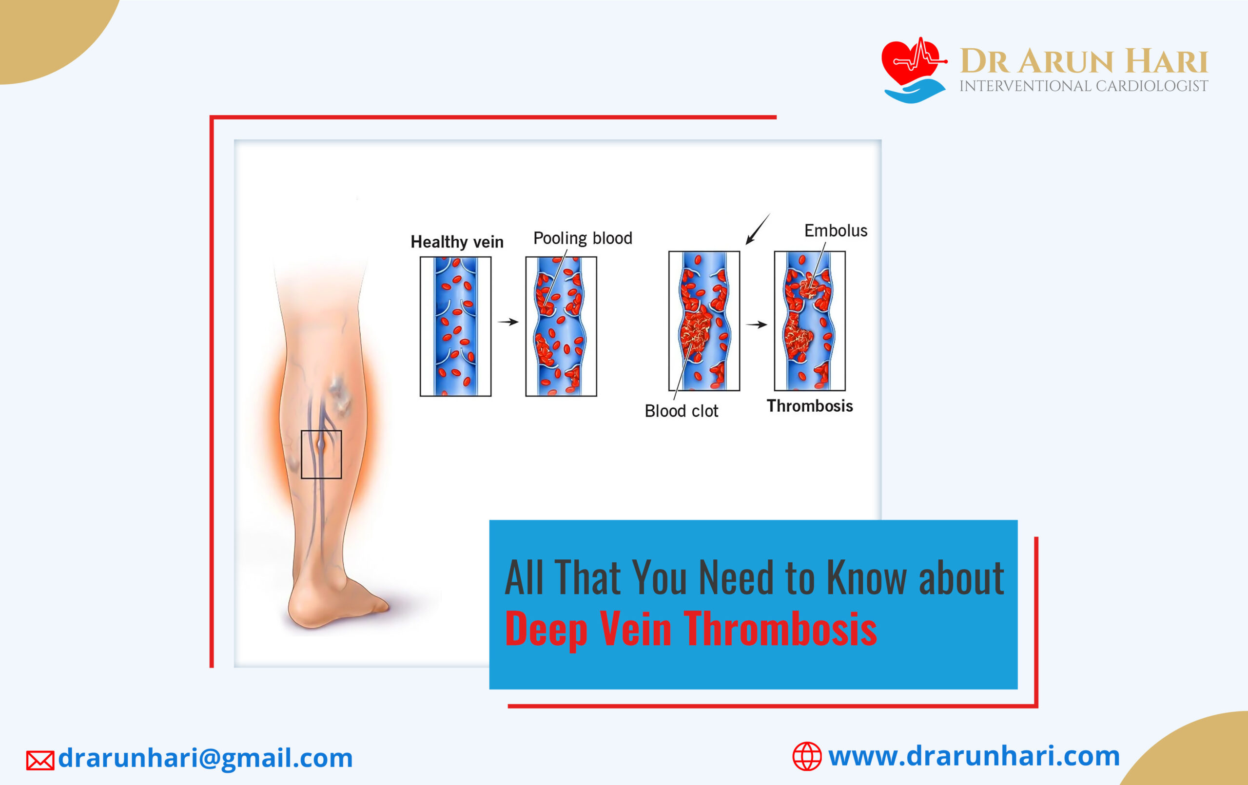 Read more about the article All That You Need to Know about Deep Vein Thrombosis