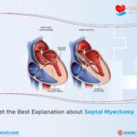 Get the Best Explanation about Septal Myectomy