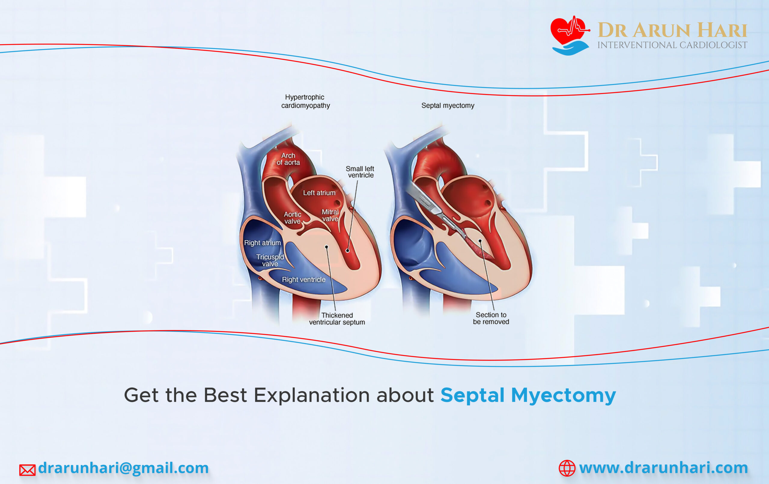 You are currently viewing Get the Best Explanation about Septal Myectomy