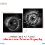 Understand All about Intravascular Echocardiography