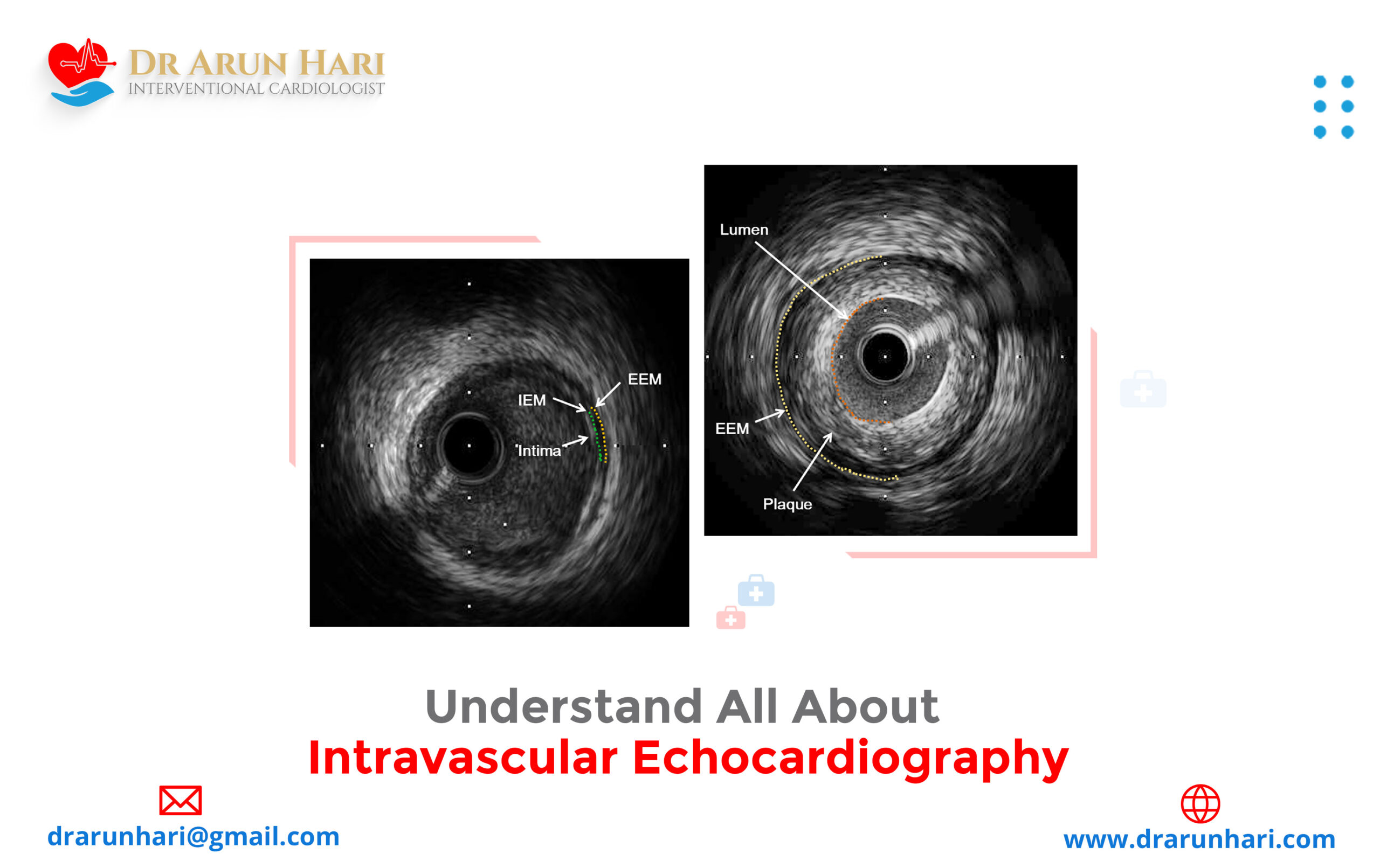 Read more about the article Understand All about Intravascular Echocardiography