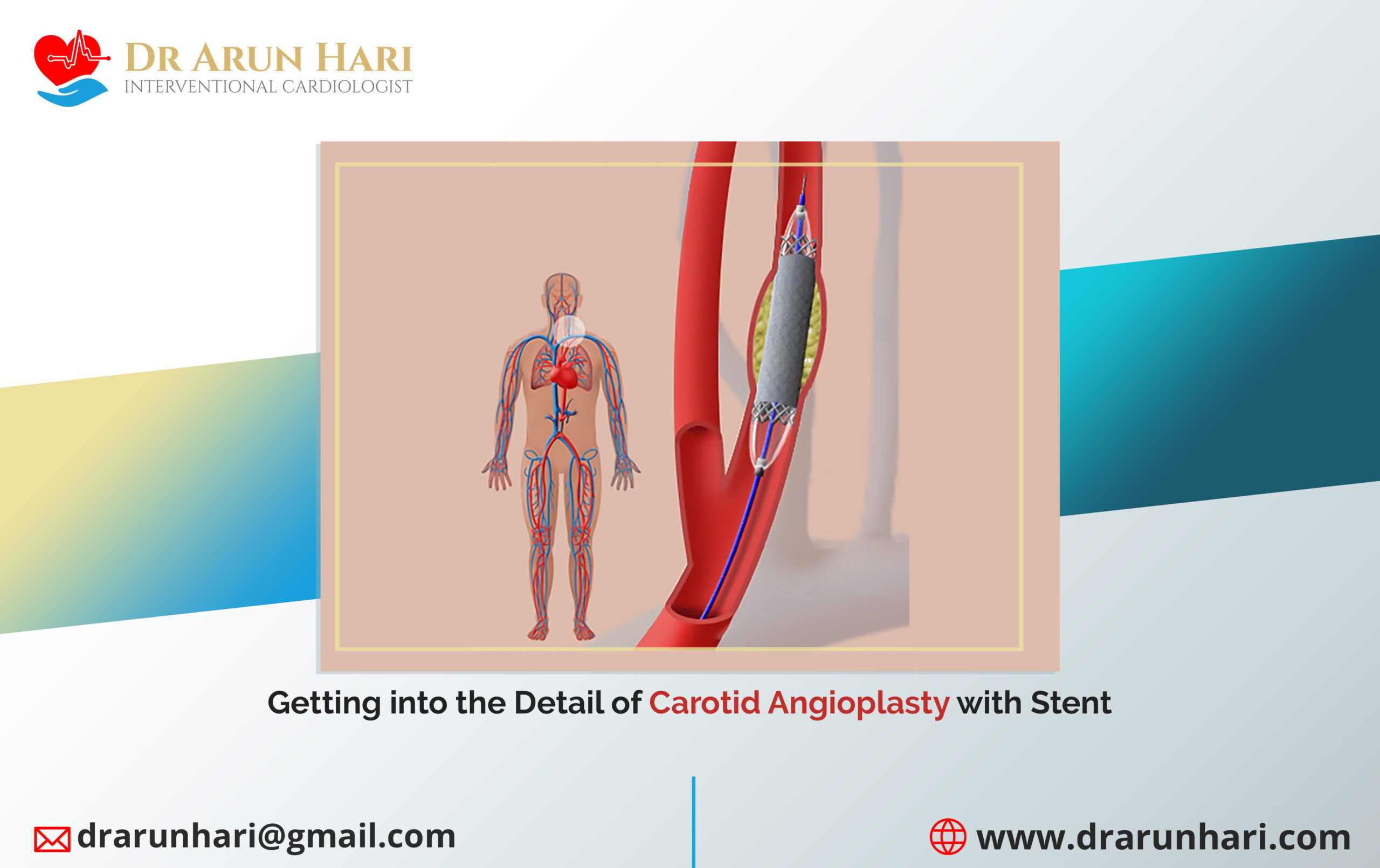 Read more about the article Getting into the Detail of Carotid Angioplasty with Stent
