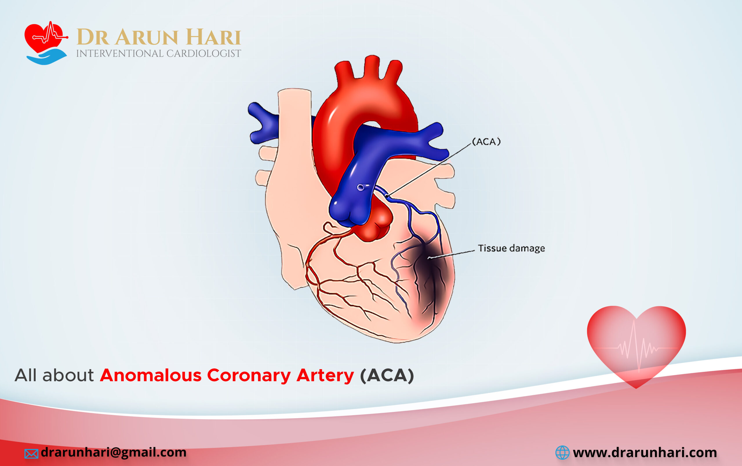 You are currently viewing All about Anomalous Coronary Artery (ACA)