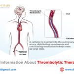 In-Depth Information about Thrombolytic Therapy