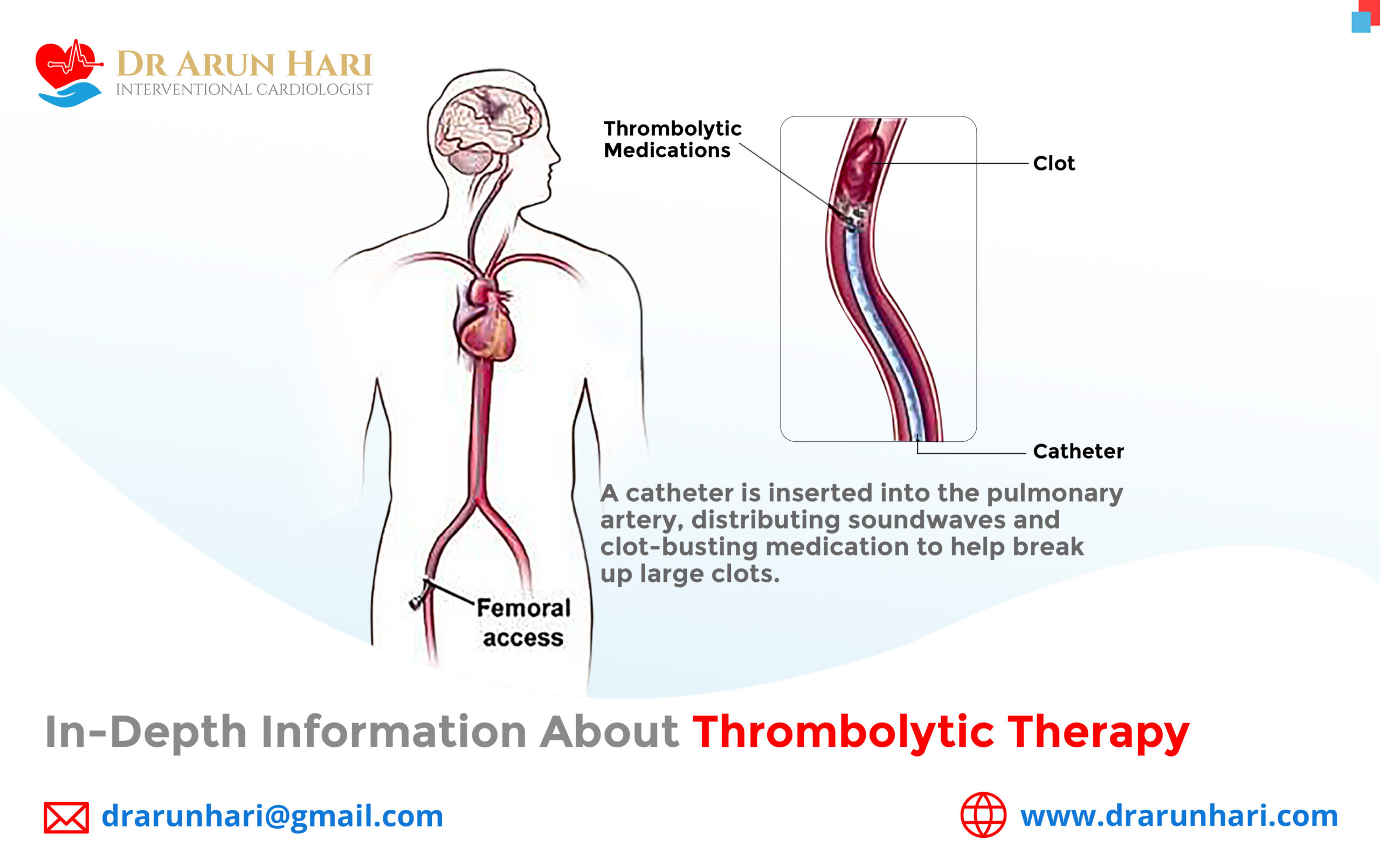 Read more about the article In-Depth Information about Thrombolytic Therapy